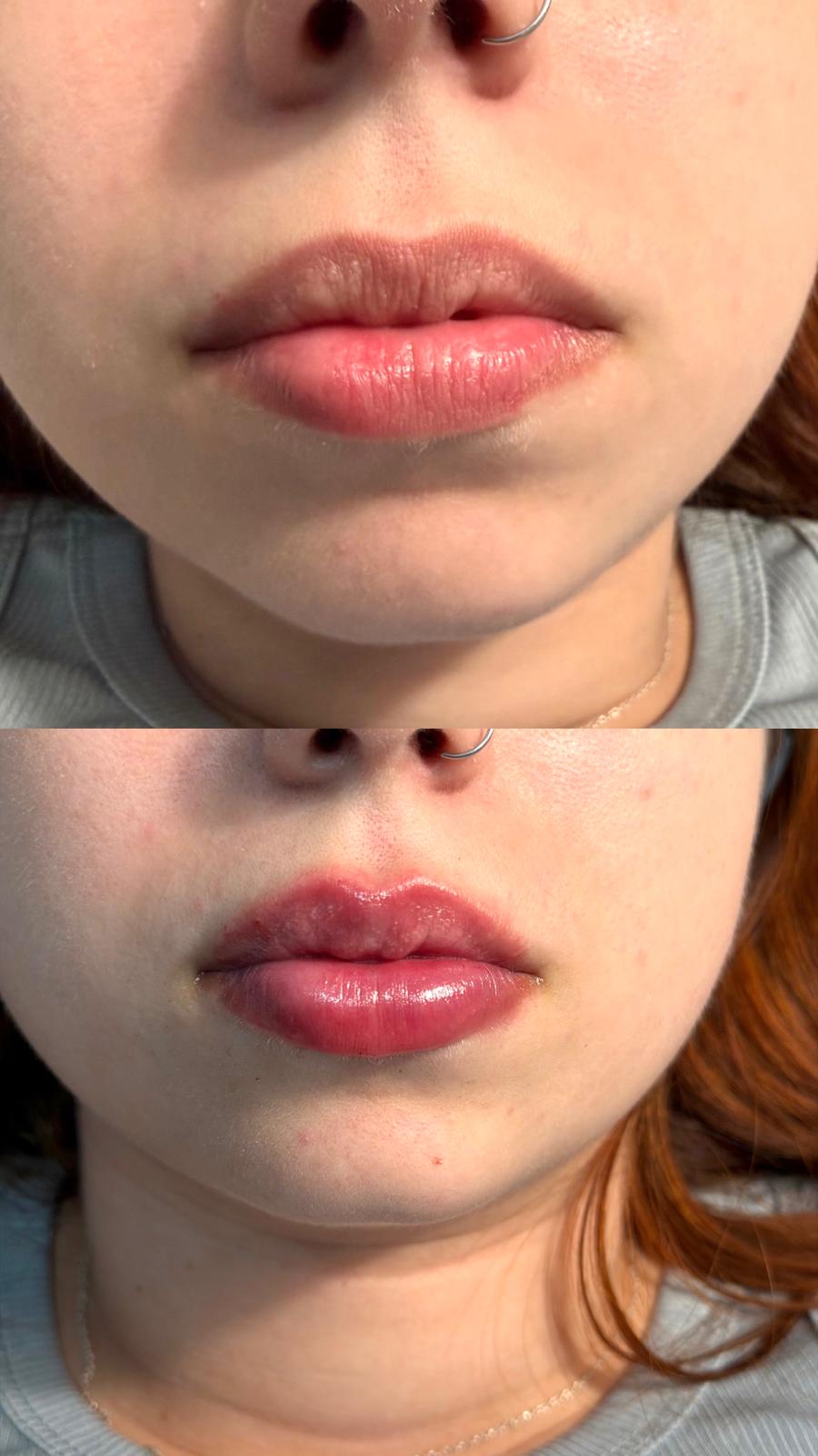 Antes y después — relleno de labios